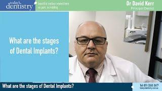 What are the stages when getting Dental Implants?