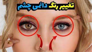 تغییر رنگ دائمی چشم | لیزر یا کاشت عنبیه؟