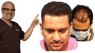 Comprehensive Tips for a Hair Transplant in India for Best Hair Transplant Result