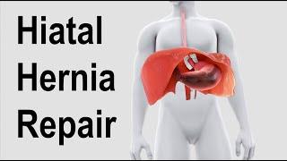 Hiatal Hernia Repair Animation