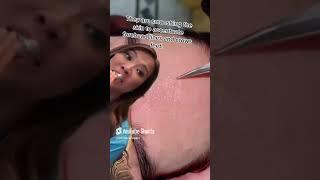 Did I hammer home that they are SMOOSHING the skin !  Dr Pimple Popper Reacts