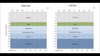 The Hearing Center at Jacksonville Hearing & Balance Institute - How To Read An Audiogram