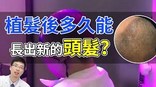 【雍禾毛髮科普】植髮效果永久？恢復期只需1年？看完驚呆了！