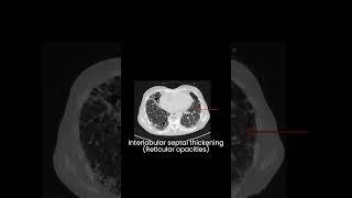 UIP- Usual Interstitial pneumonia. Idiopathic pulmonary fibrosis l Interstitial lung disease l HRCT