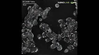 Accumulation of lipid droplets (LDs) in human pancreas adenocarcinoma cells