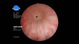 Visual Internal Urethrotomy VIU, Dr.AlAdimi