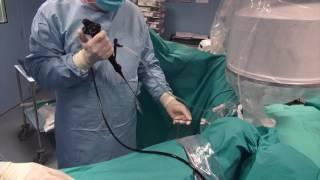 Flexible ureteroscopy for proximal ureteral stone