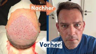 Neues Haar in Rekordzeit!  Die Transformation wird dich umhauen!