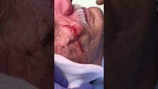 Massive Mashed Potato BLACK MARKET Facial Filler EXPLODES When Removed!