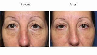 Eyelid Surgery by Dr Damian Marucci