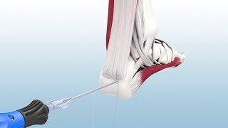 Haglund's Excision and Achilles Reconstruction Using the CuffLink™ System - CONMED Animation