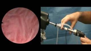 Camera optics TURP Prostate surgical procedure