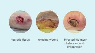 Importance of Wound Preparation