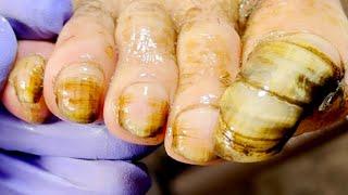 Hard Thick Nails Covered With Yellow Germs【Doctor Liu Pedicure】