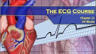 The ECG Course - AV Blocks