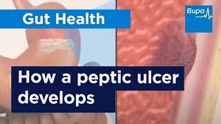 How a peptic ulcer develops | Bupa Health