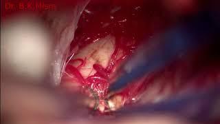 Microsurgery of midbrain cavernoma by Basant Misra