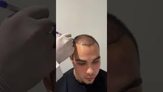 Hair Transplant in Turkey | Hair Transplant Process  #hairtransplantturkey