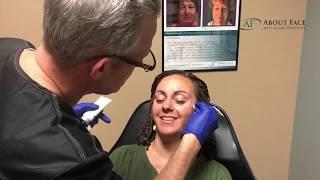 Quick Botox Treatment Video