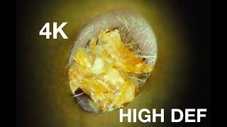 EAR WAX REMOVAL : 4K HIGH DEF : HARD DRY WAX DEEP IN EAR CANAL