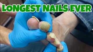 SUPER SATISFYING DEBRIDEMENT OF TOENAILS FOR DAYS 