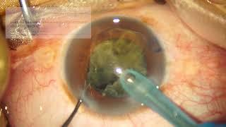 A Commentary on Diabetes and The Pupil: Phaco in 12.5 Minutes 