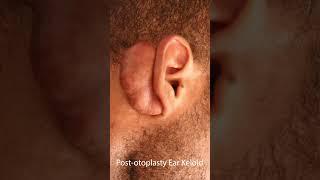 Post-otoplasty ear keloid