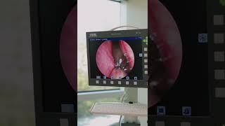 WHAT IS THAT?! #ent #entsurgery #hearingloss #nasalcongestion #sinusinfection #sinusitis #nose