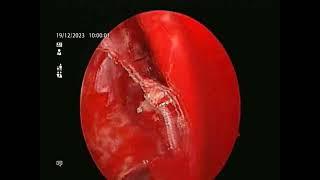 septoplasty with endoscopic sinus surgery