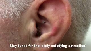 Ear Blackhead Extraction | Dr Steven Greene in Seattle