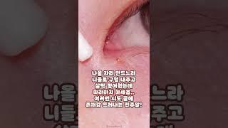 절대 따라하지 마세요.. 구경만 하세요.. #비립종