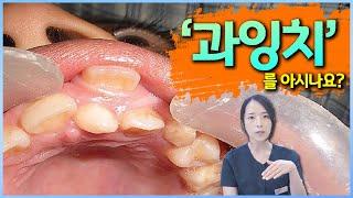 남들보다 치아 갯수가 많은 우리아이? 과잉치를 아시나요?  과잉치 치료법과 점검해야할 사항