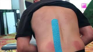 Evaluation and Taping of Lumbar Myofascial Pain and Dysfunction