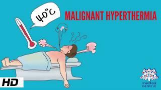 MALIGNANT HYPERTHERMIA, Causes, Signs and Symptoms, Diagnosis and Treatment.