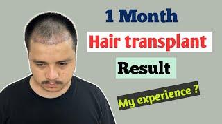 Days - 35  My Hair transplant update | Hair transplant results after 1 month in Nepal | Rabin thapa