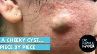 A Cheeky Cyst... Piece by Piece