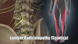 Lumbar Radiculopathy (Sciatica)