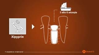 Що слід знати про зубні імплантати?
