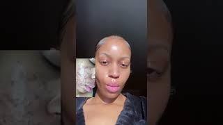 GET RID OF ACNE & HYPERPIGMENTATION