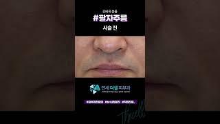 팔자주름 시술 후 4주 전/후  쥬베룩 볼륨으로 콜라겐 증가! 자연스럽게 팔자주름 없애는 방법 #팔자주름 #쥬베룩효과 #shorts