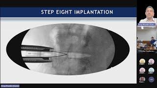 LLIF Technique: Gregory M. Mundis, Jr., MD on August 7, 2023.