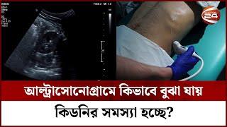 আল্ট্রাসনোগ্রামে কিভাবে বুঝা যায় কিডনির সমস্যা হচ্ছে? || Ultrasound of Kidney || Channel 24