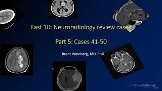 Fast 10: Neuroradiology high speed case review part 5 - Cases 41-50