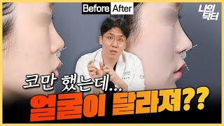 코성형 했는데 코만 바뀌는 게 아니다? 얼굴이 이렇게 바뀐다고? - 닥터 함기원