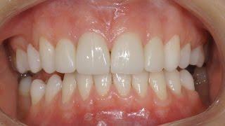 Виниры без обточки зубов. Люминиры. Veneers without teeth preparation. Carillas Dentales. 牙齿镶