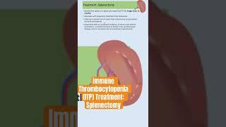 Immune Thrombocytopenia (ITP) Treatment: Splenectomy #immunethrombocytopenia #ITP #splenectomy