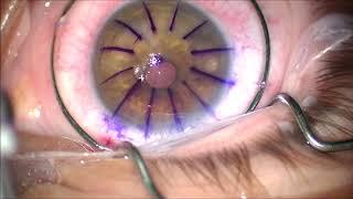 Corneal Transplant (PKP) for Keratoconus