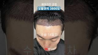 M자 탈모 모발이식 3800모 후기.. 그 결과는? (feat. 넓은 이마, 헤어라인 교정, 2주 경과)