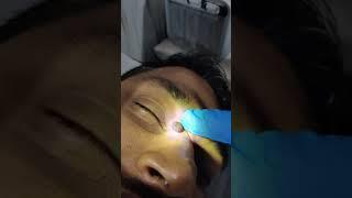 Mole and Skin Tags Removal in ZIRAKPUR and Chandigarh