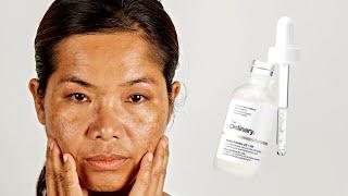 How To Use The Ordinary Alpha Arbutin 2 + HA for Hyperpigmentation